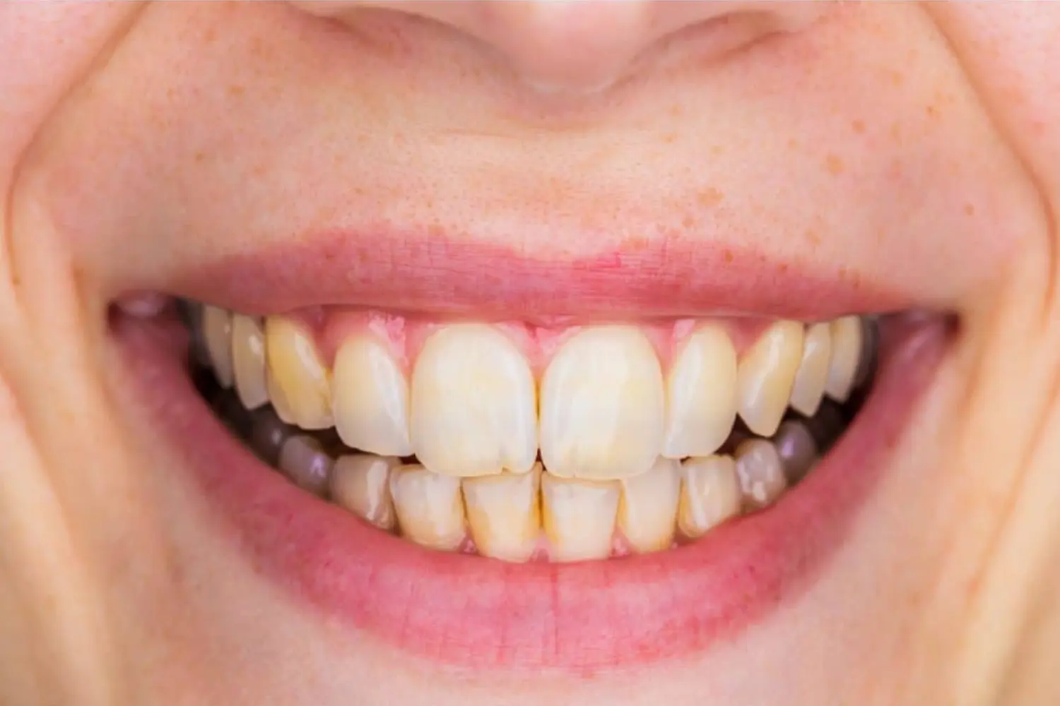 Teeth whitening White Plains