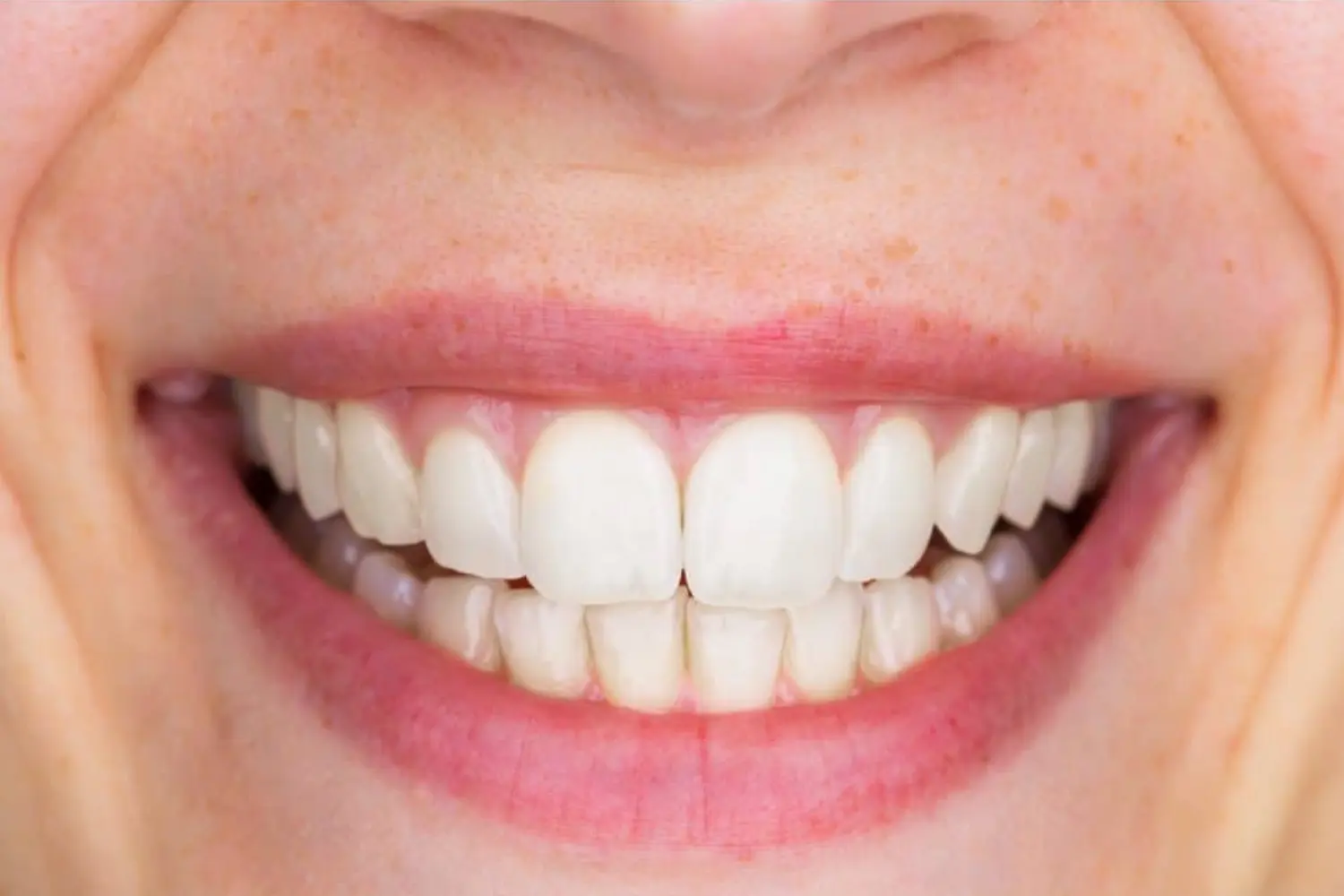 Teeth whitening White Plains