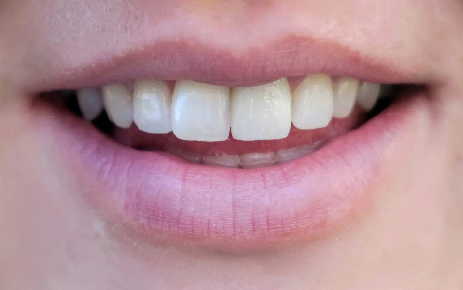 AZ Dental Implants